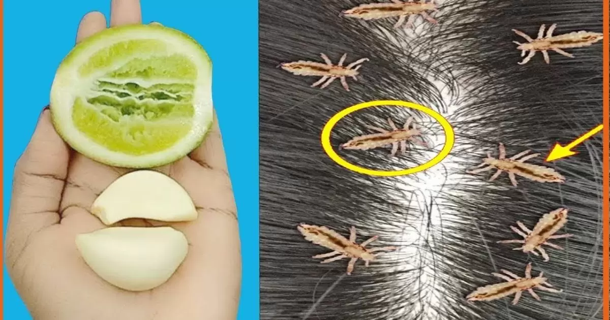 How to Remove Lice From Hair Permanently?