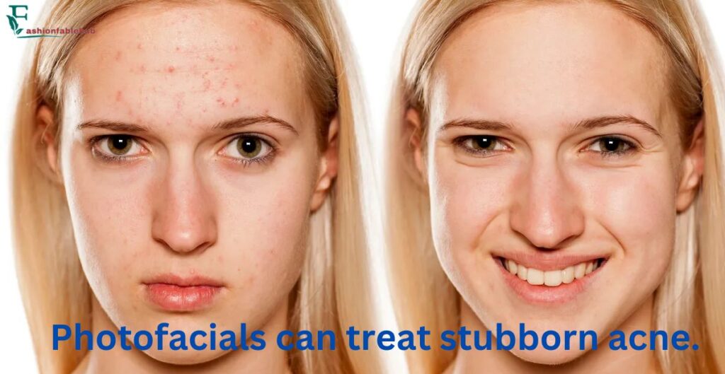 Photofacials can treat stubborn acne.