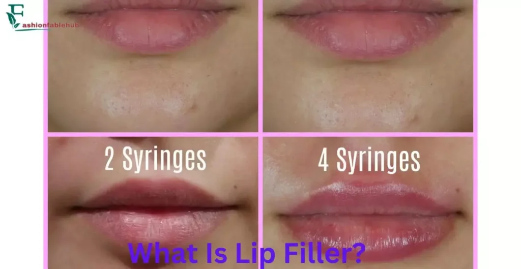 What Is Lip Filler?