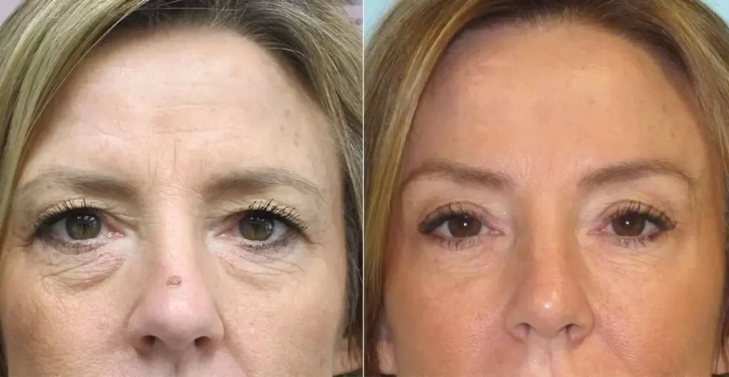 Combining Brow Lift and Eyelid Surgery