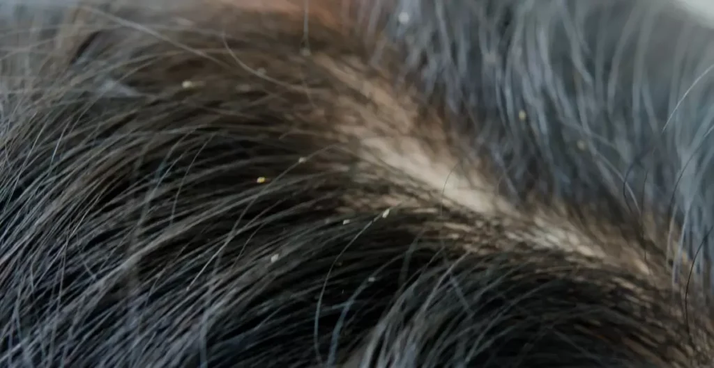 Symptoms Of Bed Bugs In Hair